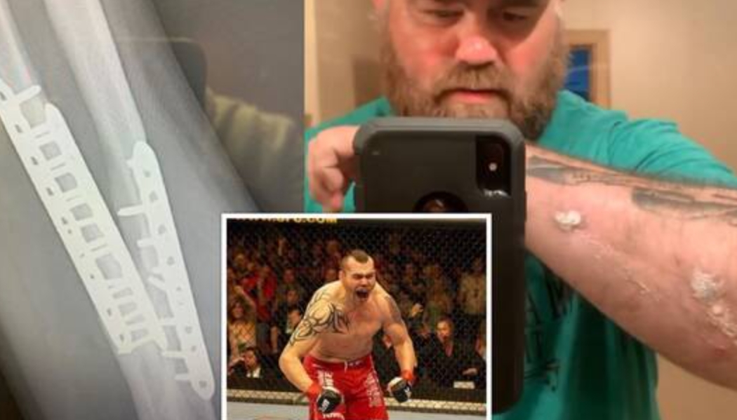 بعد رفض منظمة UFC علاجه.. بطل رفع أثقال أمريكي يلجأ لمتابعيه للشفاء من هذه الإصابة الخطيرة !